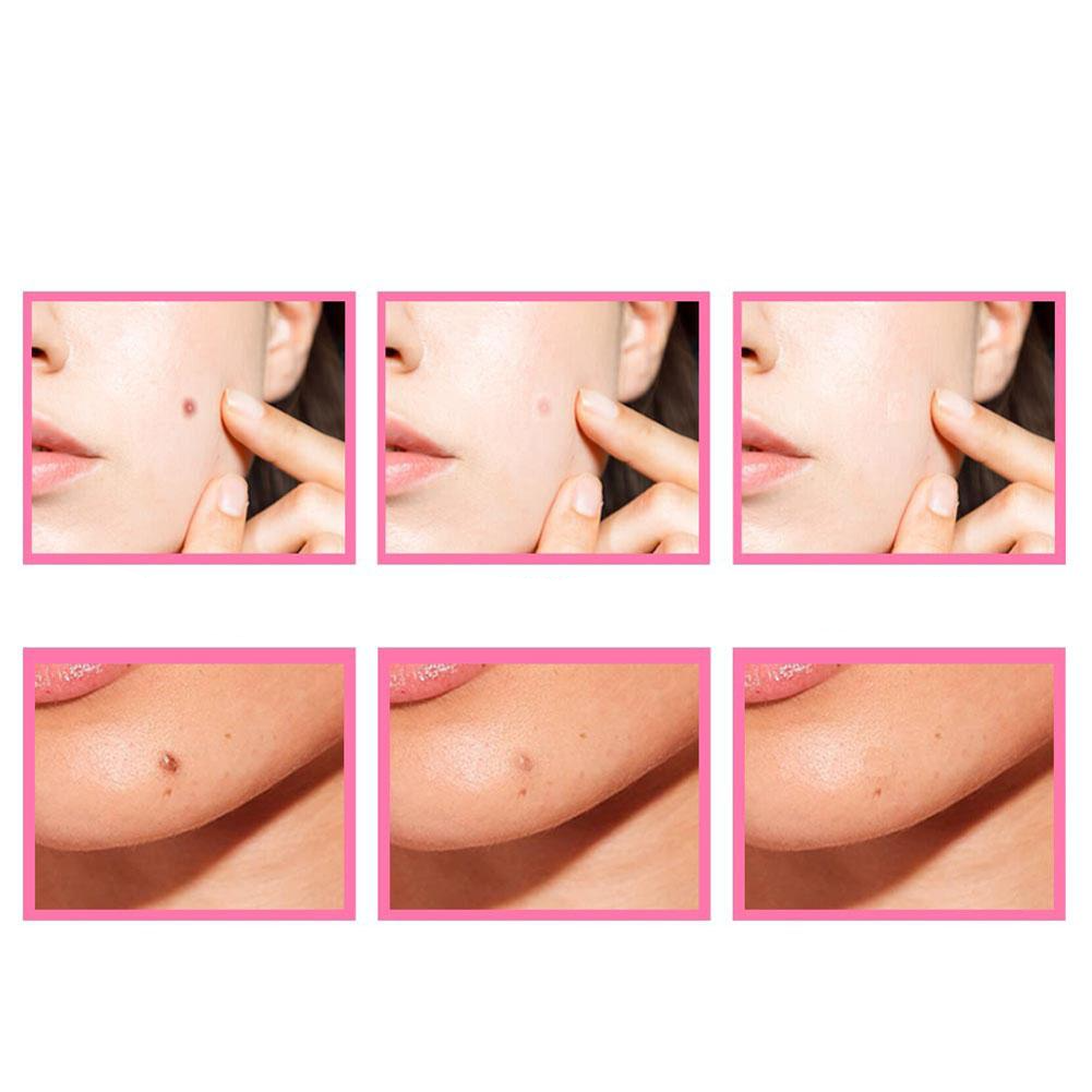 HerbCare™ Siero biologico per le imperfezioni della pelle | Rimuovi permanentemente le antiestetiche macchie cutanee!