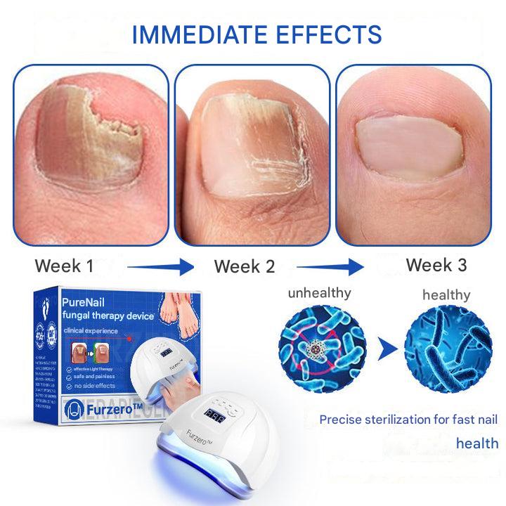 ClearZap™ Apparecchiature per la terapia laser degli stampi