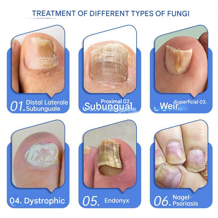 ClearZap™ Apparecchiature per la terapia laser degli stampi