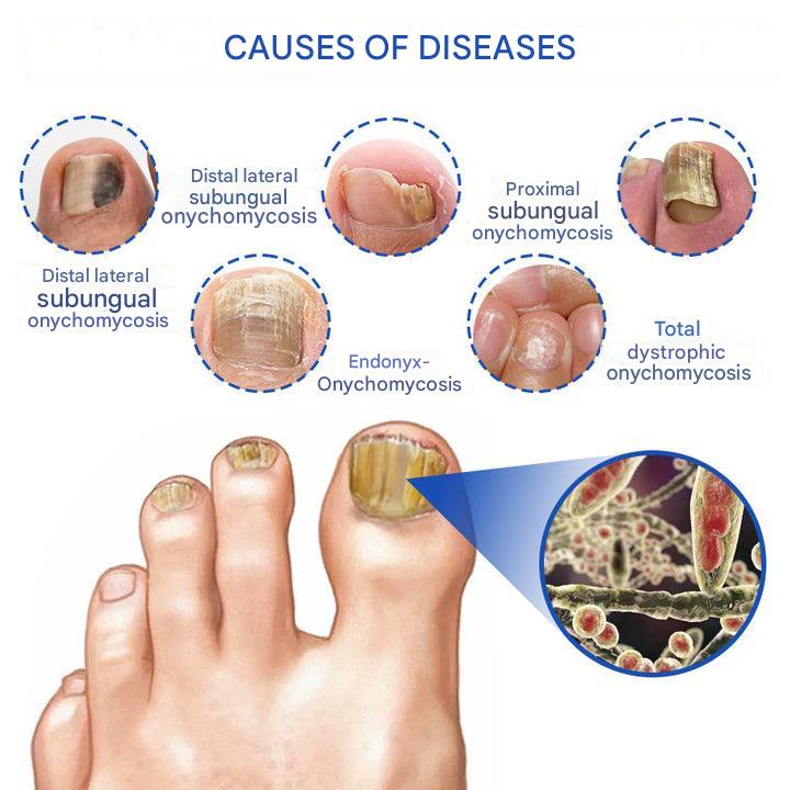 ClearZap™ Apparecchiature per la terapia laser degli stampi