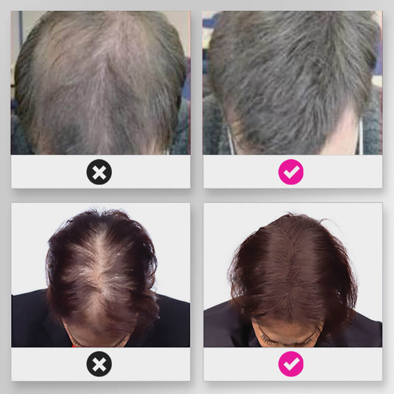EELHOE HAIR™ Polvere contro la caduta dei capelli e riempimento rapido dell'attaccatura dei capelli