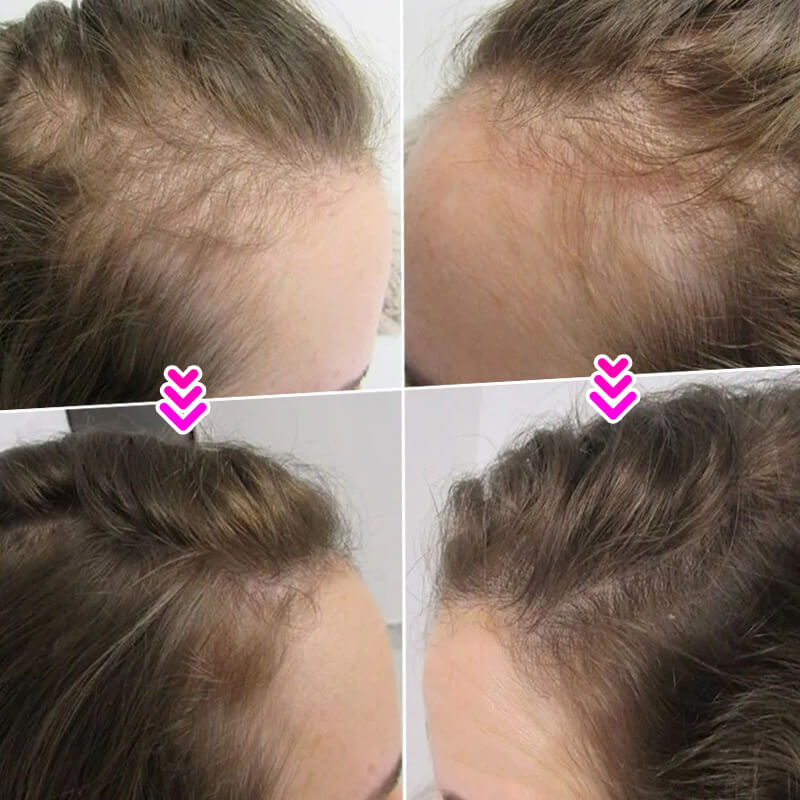 EELHOE HAIR™ Polvere contro la caduta dei capelli e riempimento rapido dell'attaccatura dei capelli