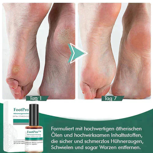 FootPro™️ Gel per la rimozione dei calli