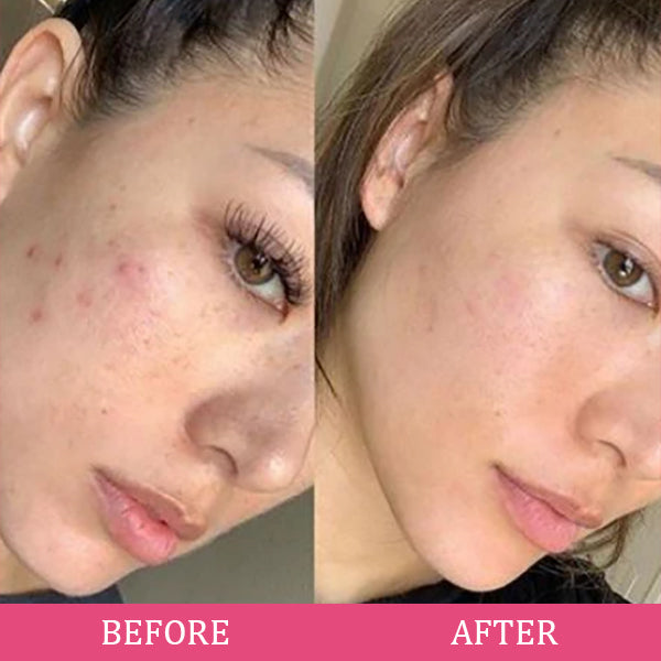 NueDerma™ Bacchetta per la cura della pelle ad alta frequenza