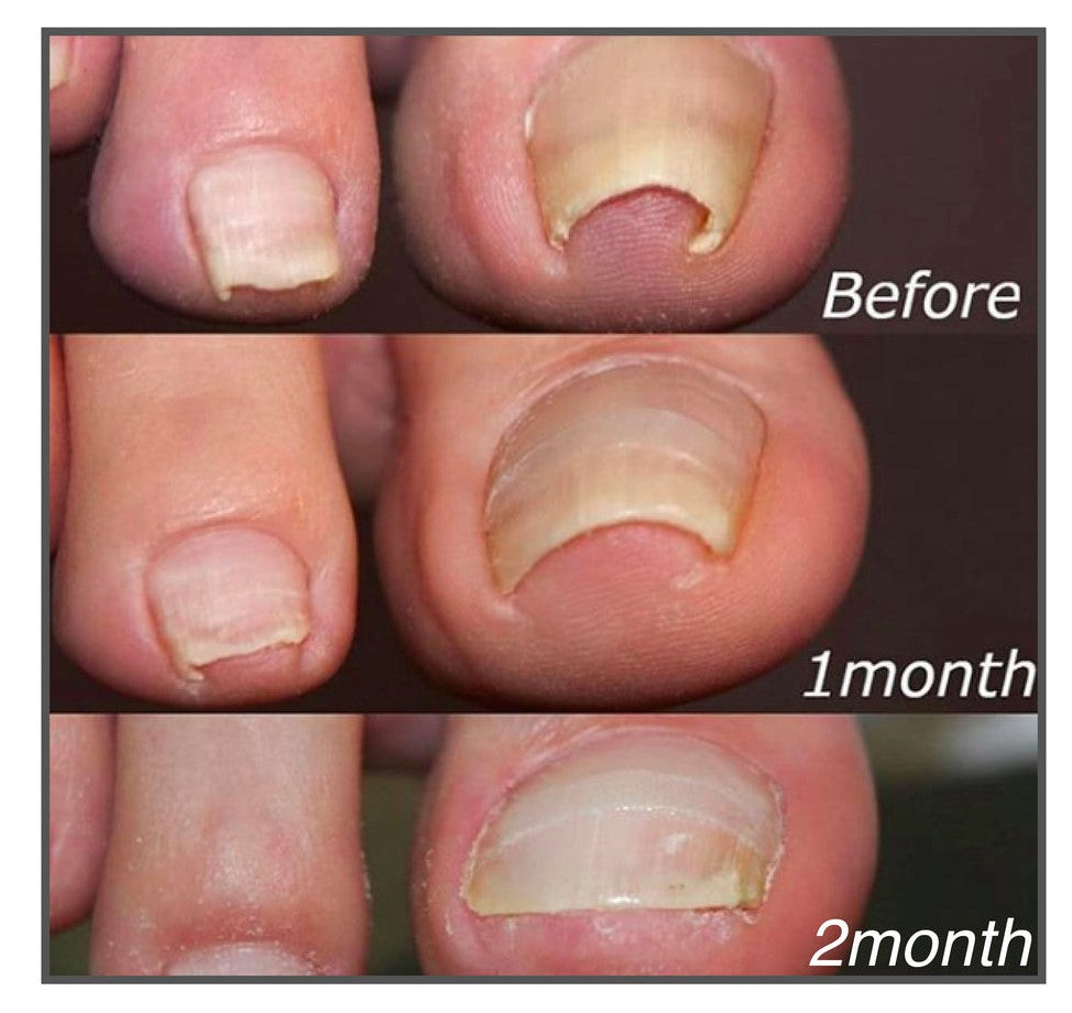 ToeFix+ Medicazioni per unghie | Sbarazzati dei funghi delle unghie per sempre!