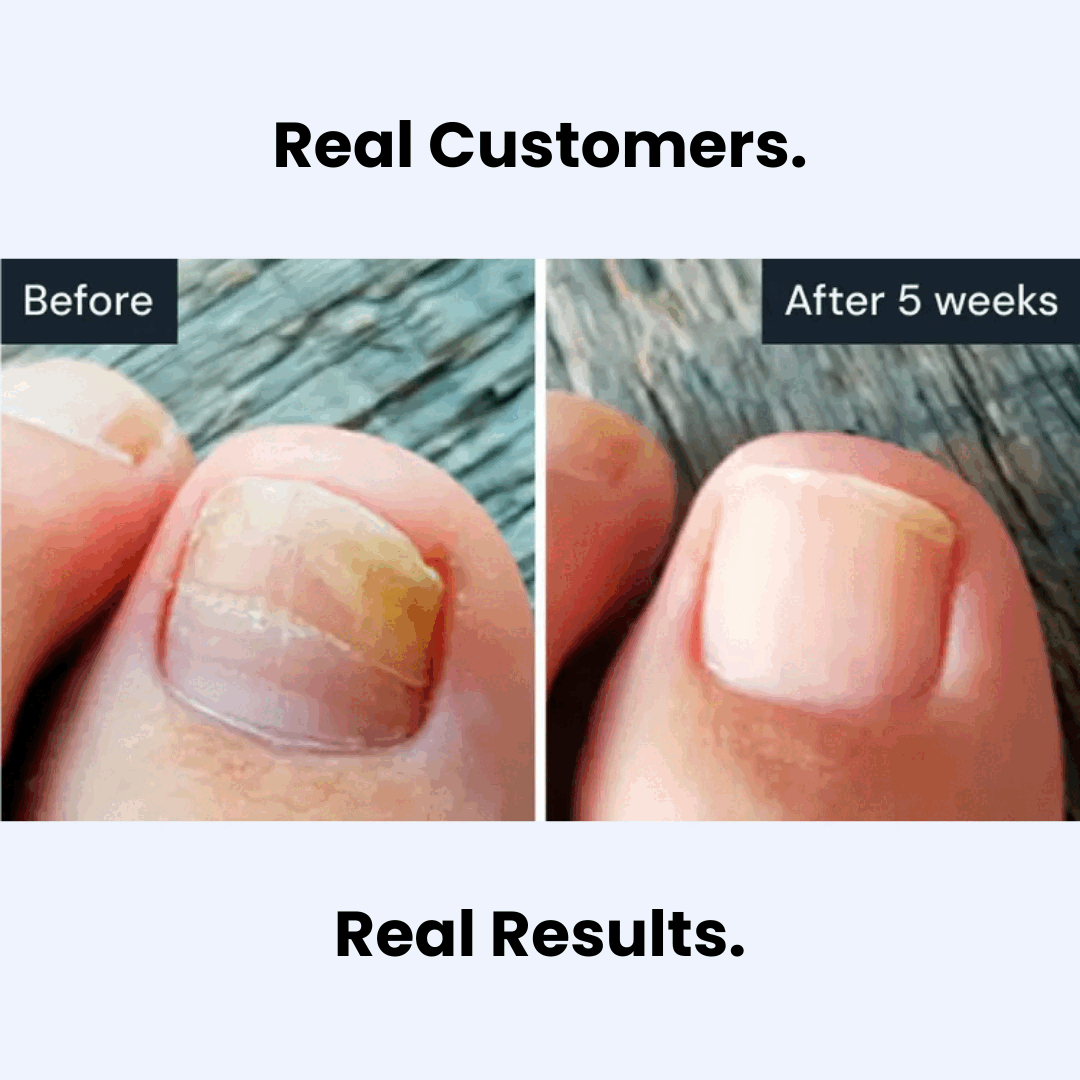 NailClear Pro+™ Penna rigenerante per unghie più sane e chiare